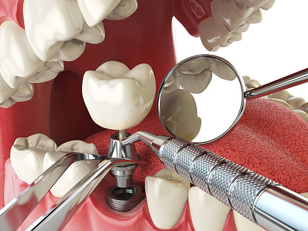 Best Emergency Root Canal Treatment in Owasso, OK
